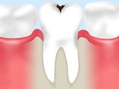 初期の虫歯は再石灰化療法で治しましょう