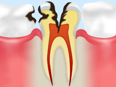 重度の虫歯は根から治療が必要です