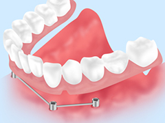 インプラント義歯