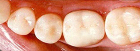 銀歯を白い歯に変えること