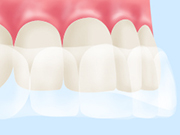 ご自宅でご自分のペースで白くできるホームホワイトニング