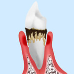重度の歯周病　症状