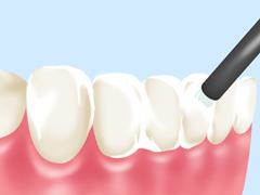 フッ素塗布とシーラント（予防?塞）