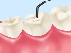 フッ素塗布とシーラント（予防?塞）